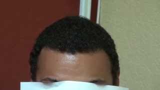 Dense Black Hair Transplant Hairline Restoration Result Bald Treatment Dr Diep wwwmhtacliniccom [upl. by Bel632]