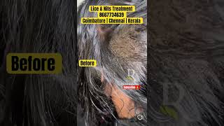 Lice nits removal treatment  lice treatment  lice removal  lice how to remove the nits from hair [upl. by Llevram]