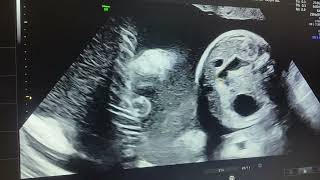 Double bubble sign  ultrasound fetus  duodenal atresia associated polyhydramnios seen [upl. by Fiann]