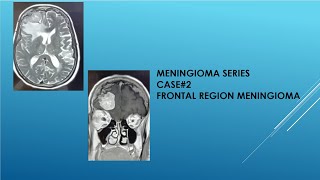 CASE  2 RIGHT FRONTAL REGION MENINGIOMA [upl. by Phelgon]