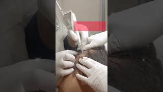 Seborrheic keratosis treatment  Laser Treat [upl. by Tasiana]