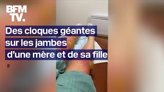 Des cloques géantes apparaissent sur les jambes d’une mère et de sa fille après une sortie au lac [upl. by Ecylahs382]