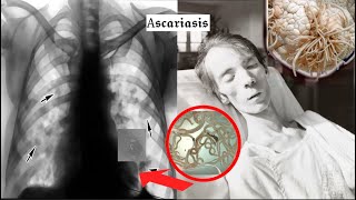 The HORRIFIC History of Ascariasis [upl. by Bivins]