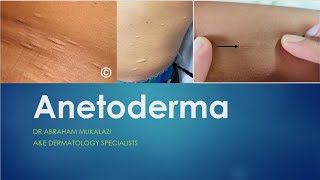 ANETODERMA BY DR ABRAHAM dermatology scarystory skincareeducation funny ANETODERMA [upl. by Erait]