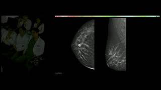 Carcinoma ductal infiltrante Dra Karla Chavez [upl. by Negeam665]