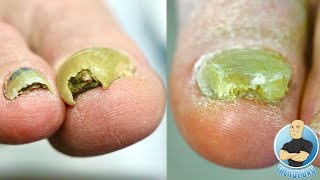 CUTTING AND TRIMMING SUPER THICK TOENAILS HOW TO MANAGE HARD TO CUT TOENAILS [upl. by Adiell]