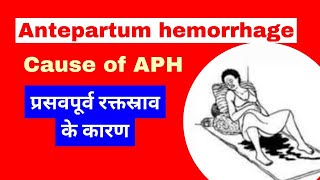 Antepartum hemorrhage in hindi  APH in pregnancy  cause of aph [upl. by Eded]