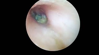 OTITIS EXTERNA Izquierda [upl. by Ylliw]