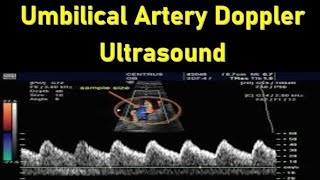 Umbilical Artery Doppler Ultrasound Interpretation  Doppler Ultrasound in Fetal Growth Assessment [upl. by Kalagher]