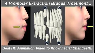 Changes in Face After 4 1st Premolars Extraction amp Braces Treatment Best HD Animation  Dr Ram MDS [upl. by Auqined]