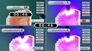 Direct restoration UNIVERSAL BOND II in comparison  TOKUYAMA DENTAL [upl. by Itin960]