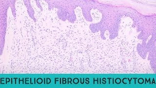 Epithelioid fibrous histiocytoma benign ALK1 skin tumor ALK gene fusion pathology dermpath [upl. by Schuh]