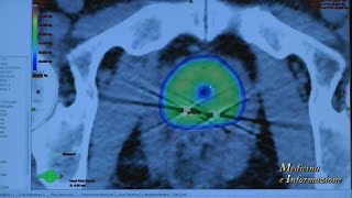 Tumore alla Prostata nuovi farmaci ormonali orali prechemioterapia [upl. by Amandy156]