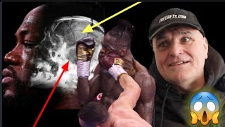 BREAKING NEWS❗ OH OHHH DEONTAY WILDERS SKULL IS CRACKED BECAUSE OF TYSON FURY ❗🚨 [upl. by Salazar]