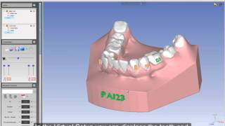 Planmeca Romexis® 3D Ortho Studio – Teeth Segmentation and Virtual Setup [upl. by Eveleen]