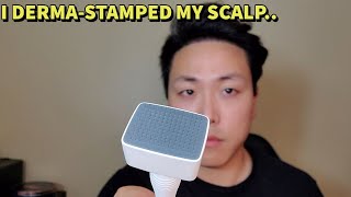 I USED A DERMA STAMP FOR HAIR GROWTH AND THIS IS WHAT I THOUGHT OF IT [upl. by Casimir]