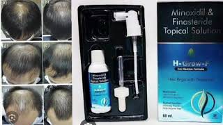 HGrow F Hair Restore Formula Minoxidil amp Finasteride Topical Solution [upl. by Dazraf]