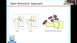 Management of Fracture Neck Femur in Children by Dr Sandeep Vaidya [upl. by Bosson749]