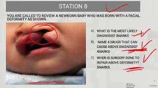 Cleft Lip Case Study [upl. by Uzziel]