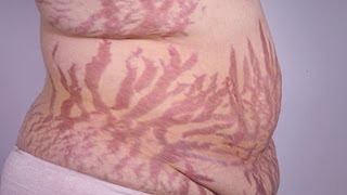 Does Liposuction Reduce Stretch Marks Liposuction Specialist Trevor Schmidt PAC MyShape Lipo [upl. by Jonette297]