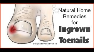 Natural Home Remedies for Ingrown Toenails [upl. by Ardisj]