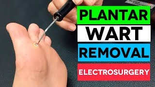 FAST Plantar Wart Removal By Electrosurgery [upl. by Ecyak939]