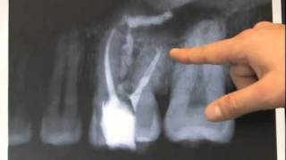 Endodontic Case  Found Calcium Hydroxide [upl. by Virnelli]