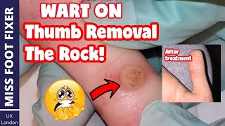 Wart On Thumb Removal Full Treatment By Miss Foot Fixer [upl. by Sarilda]