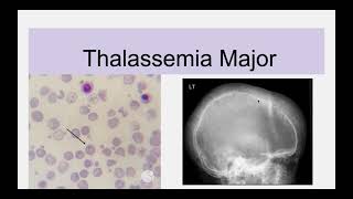 Hemolytic Anemias Part 6 Beta Thalassemia Pathogenesis types Diagnosis amp Treatment [upl. by Lunetta]