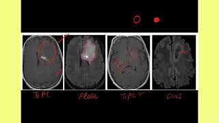 tkrhtp04 HOW TO APPROACH BRAIN LESION ON MRIA CASE OF TUMEFACTIVE DEMYELINATION AND DDS🚦 [upl. by Eenar]