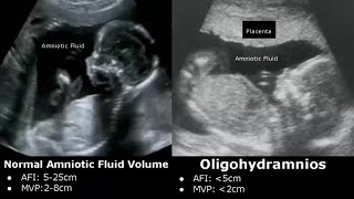 Obstetric Ultrasound Normal Vs Abnormal Images  Fetal Placenta Umbilical Cord Pathologies USG [upl. by Ellinej]