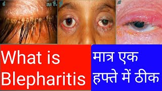 What is Blepharitis।How to Get Rid Out Of Blepharitis In Hindi।Blepharitis Treatment [upl. by Ardath]