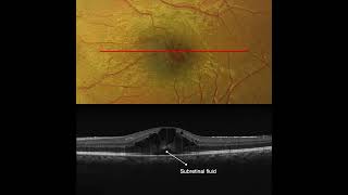 Cystoid Macular Edema in Pars Planitis OCT Interpretation [upl. by Aneehsram332]