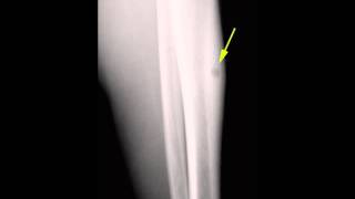 Osteoid Osteoma Tibia on X ray [upl. by Ojaras]