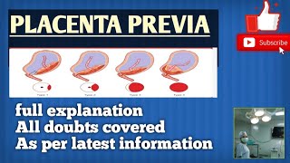 Placenta previa in Hindi full explanation Easy notes [upl. by Butterworth882]