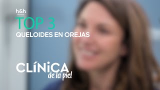 Top 3 Queloides en orejas  Clínica de la piel  Discovery Home amp Health [upl. by Nuy]