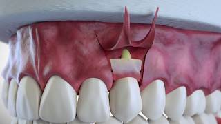 Subepithelial Connective Tissue Grafting [upl. by Quirita]