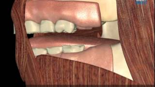 How Myobrace Works What are the causes of crooked teeth Myobrace [upl. by Doss]