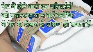 पेट के कैंसर के लक्षणpet ke cancer ke lakshanstomach cancer symptoms [upl. by Macswan]