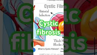 Cystic fibrosis [upl. by Aremahs]