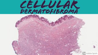 Cellular Dermatofibroma Cellular Fibrous Histiocytoma 5Minute Pathology Pearls [upl. by Marb]