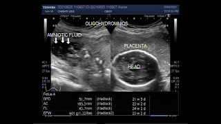 Oligohydramnios with loss of fetal movements and Pregnancy of about 23 weeks [upl. by Tiffanie23]