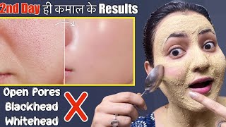 Skin Transformation Challenge Day 2  Remove Open Pores Blackhead Whitehead Naturally in 5 Days💕 [upl. by Edora417]