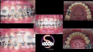 Bimaxillary protrusion treated without extraction🤔 Mostafa Elshafey [upl. by Calore775]