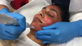 Microneedling treats fine lines enlarged pores and uneven skin texture [upl. by Ellivnarg]