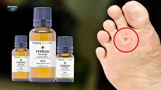 How To Get Rid Of Warts Fast with Healing Natural Oils HWarts Formula [upl. by Luhem]