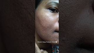 1 Month Using Tretinoin Daily to see the effect viralvideo tretinoin shorts youtubeshorts [upl. by Cote146]