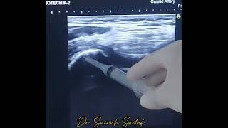 intraarticular Knee injection for OA knee joint by Dr Sairah Sadaf [upl. by Ahsi246]