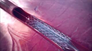 Coronary Aspiration Catheter Animation  Penumbra [upl. by Christiane]