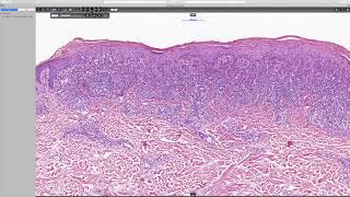 Lichenoid keratosis Phillip H McKee Antonina Kalmykova amp CSD Health Care [upl. by Elliven963]